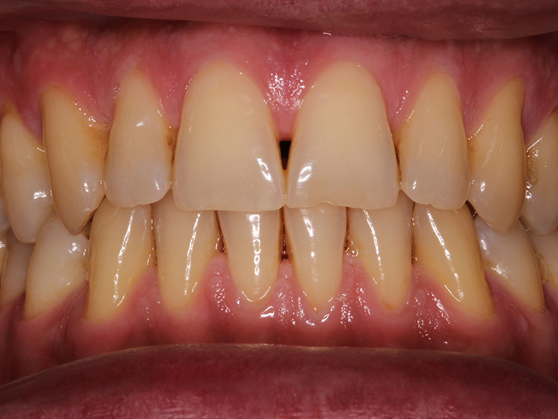 clinicaculto-blanqueamiento-a