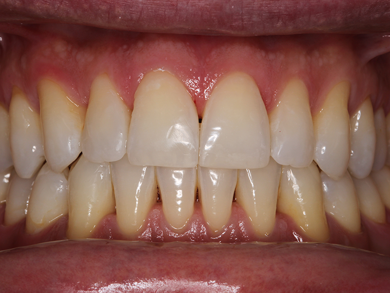 clinicaculto-blanqueamiento-b